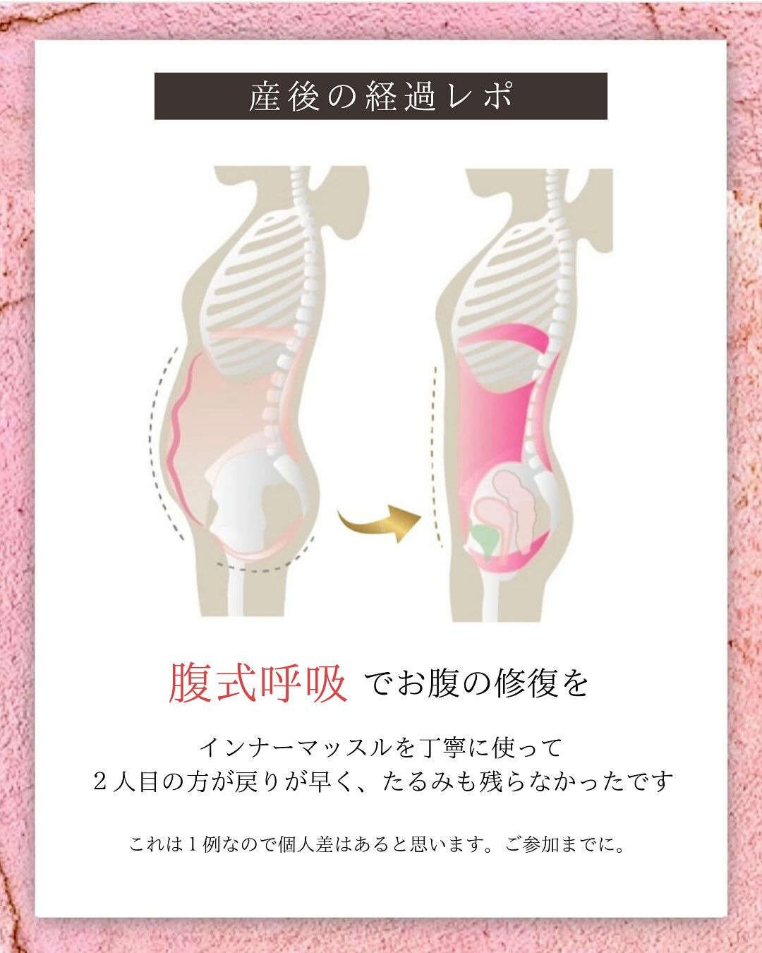 昨年末に第２子を出産しました