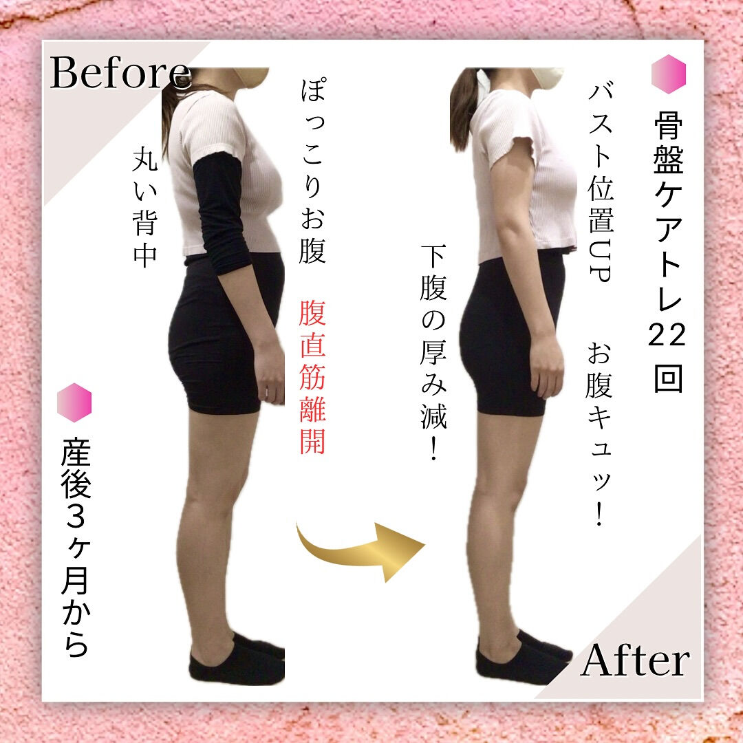 産後腹直筋離開｜お客様BeforeAfter