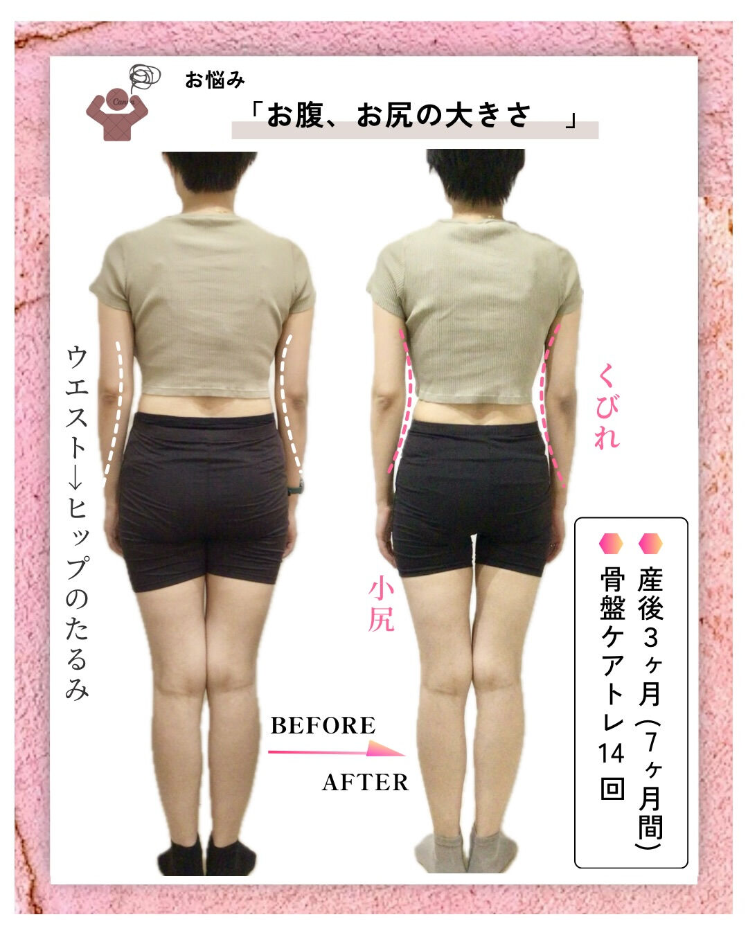産後の骨盤矯正（骨盤ケアトレ）BeforeAfter