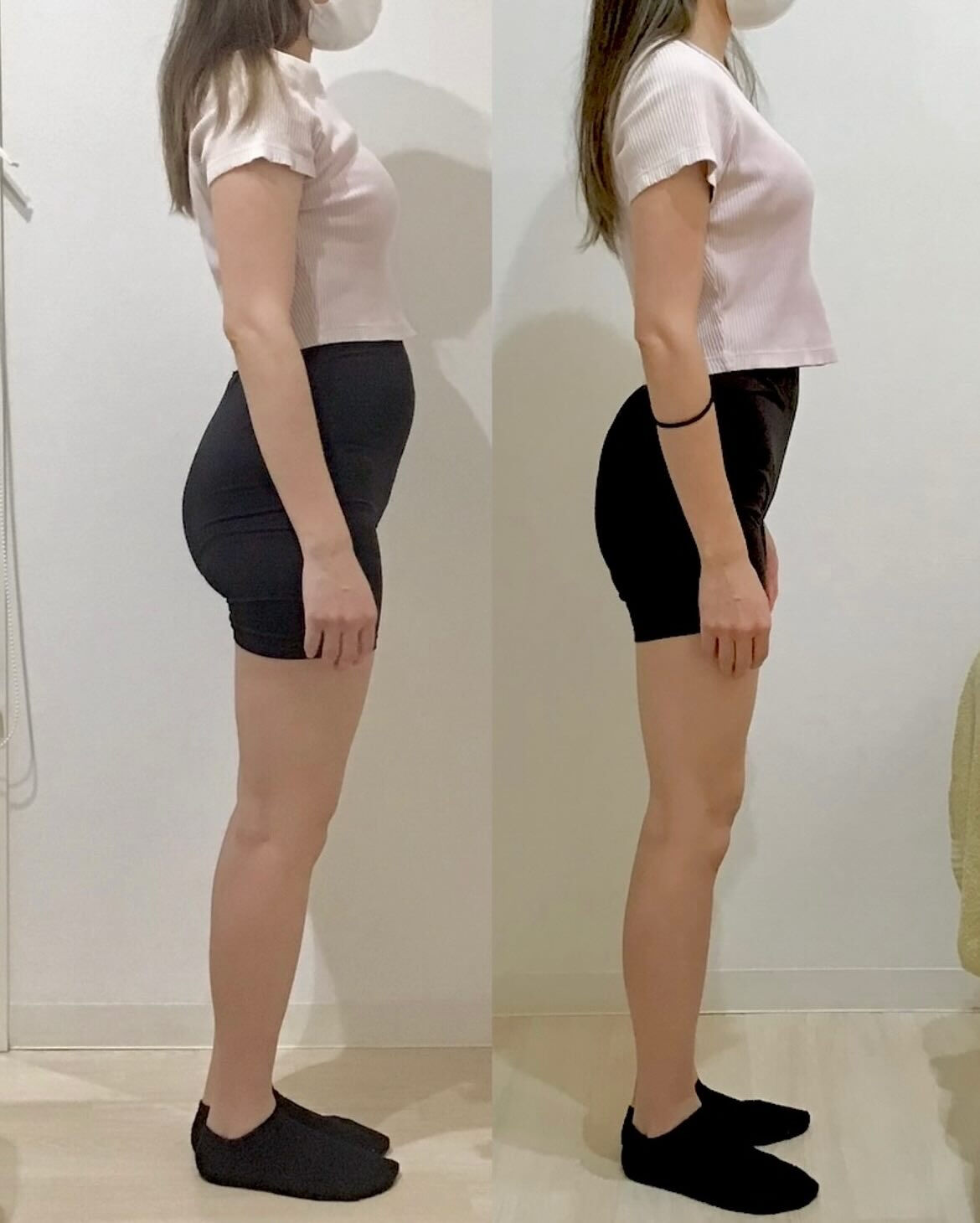 産後の骨盤矯正（骨盤ケアトレ）BeforeAfter